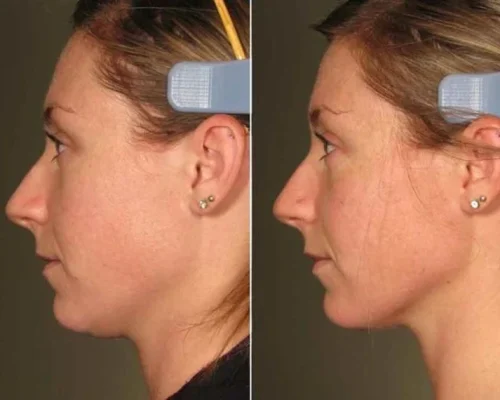 2d274905752145-ultherapy-before-after-face-neck-today-inline-large