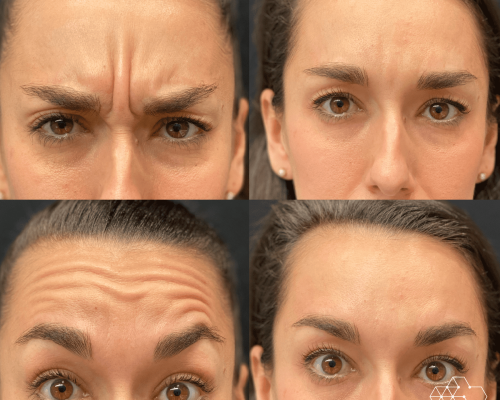 Top-5-Facial-Areas-for-Botox-Treatments